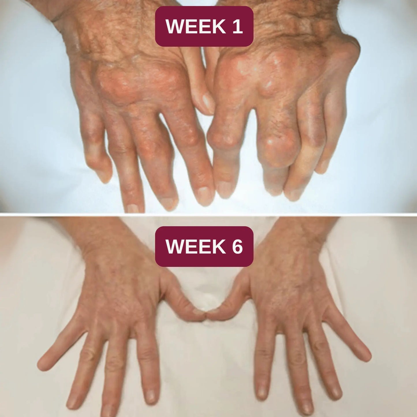 Before and after comparison of hands labeled 'Week 1' and 'Week 6' on a white background.